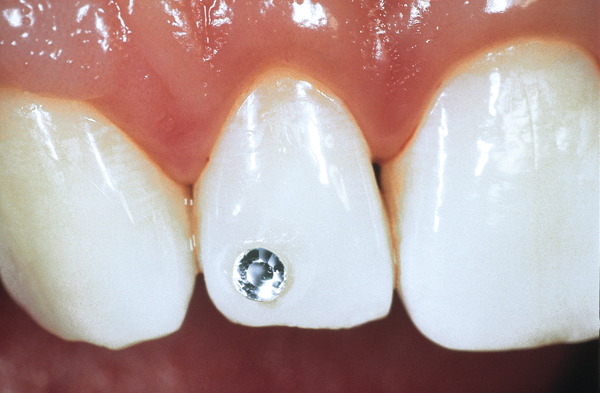 Skyce tandsmykker i krystal  2,5 mm, 5 stk.