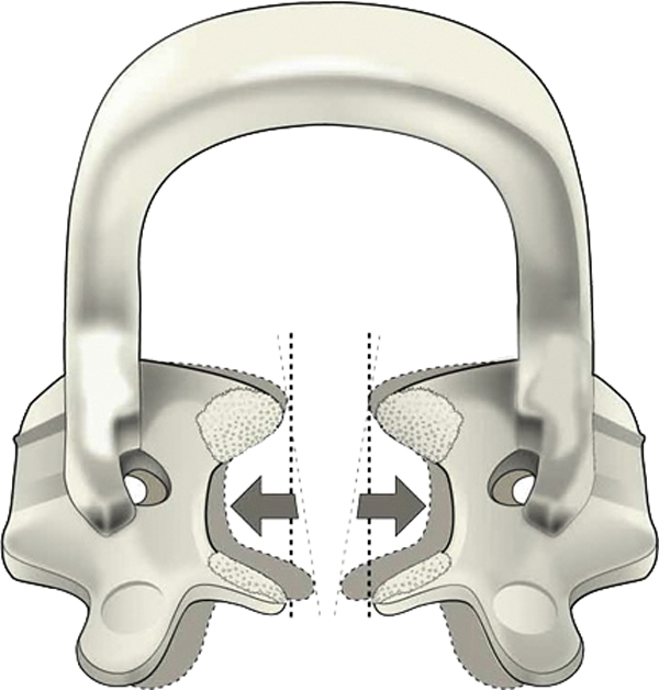 Kerr SoftClamp General Kit
