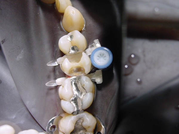 Luciwedge kiler nr. 771S små, 100 stk.