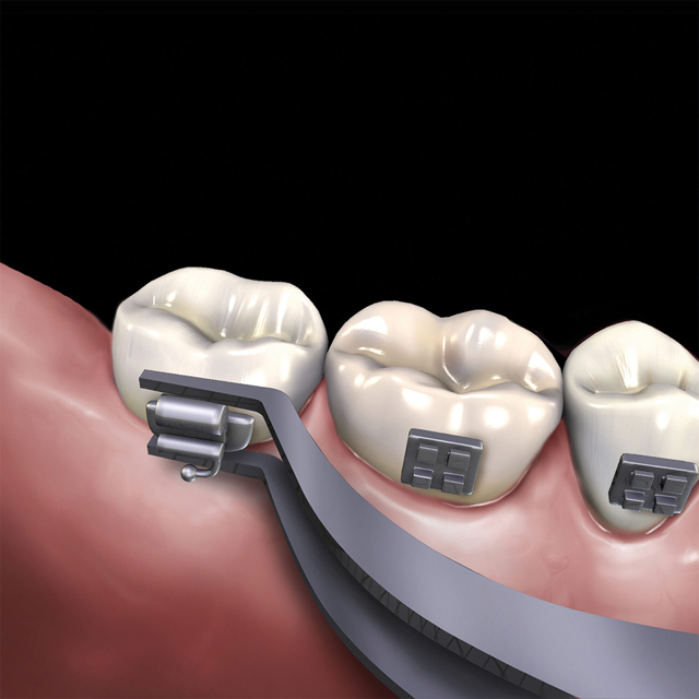 Hu-Friedy Slim Buccal Tube Holder
