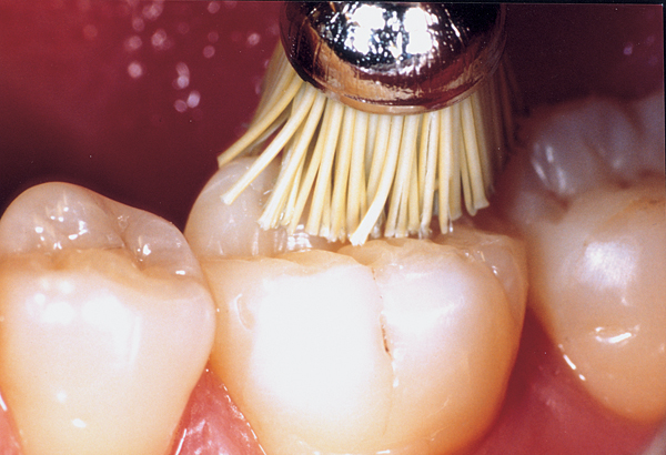 Occlubrush, reg. kop, 3 stk.